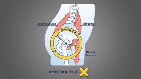 Anterior Pelvic Tilt: 3 Stretches and 3 Exercises to Remedy - Inspire US