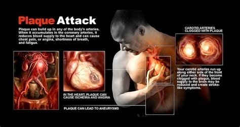 Plaque Attack - StoryMD