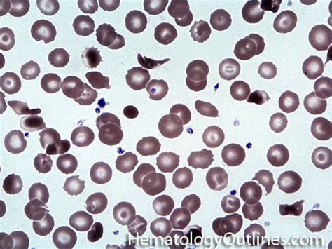 HematologyOutlines - Glossary