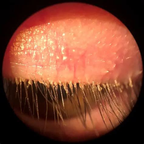 Understanding Demodex Blepharitis: Causes, Symptoms, and Treatment ...