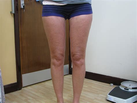 Selston Cosmetic Clinic: Vaser Lipo Inner Thighs Before And After