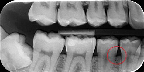 coloration discoloration - What does cavity look like on X ray? - Medical Sciences Stack Exchange