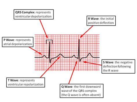 Medicowesome: Mnemonics and basics of ECG interpretation