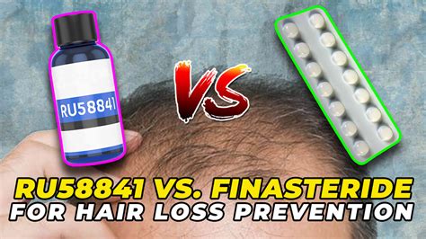 RU58841 Vs. Finasteride For Hair Loss Prevention - Which Is Better?