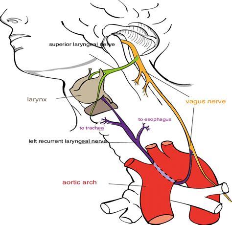 Vagus Nerve Palsy