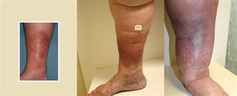 Lipodermatosclerosis – Carolina Vein Center, Durham, Raleigh, Pinehurst, North Carolina