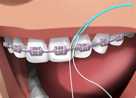 What is the difference between Superfloss, floss threaders, floss picks and dental floss? | News ...