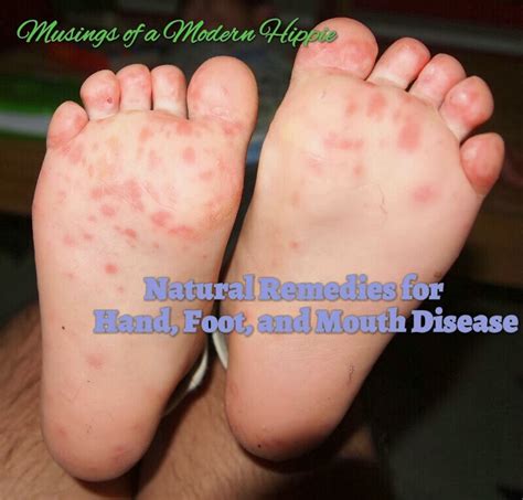 Natural Remedies for Hand, Foot, and Mouth Disease