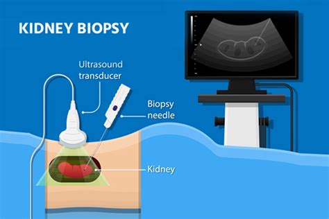 Complications After Renal Biopsy