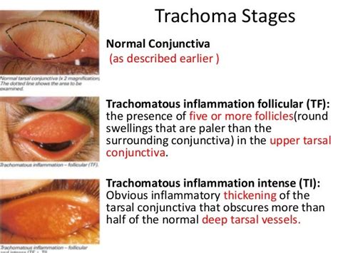 Trachoma