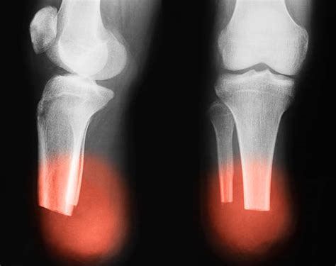 Best Broken Leg Xray Stock Photos, Pictures & Royalty-Free Images - iStock