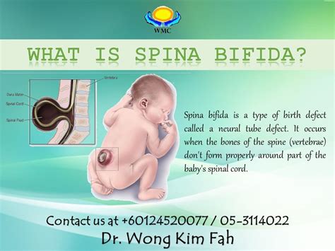 Is your child suffering from spina bifida? What is SPINA BIFIDA? Spina ...