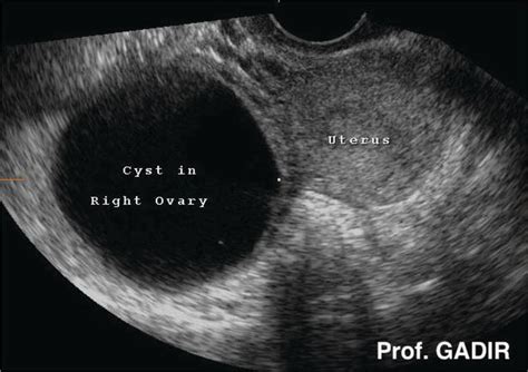 Ovarian Cancer Tumor Ultrasound