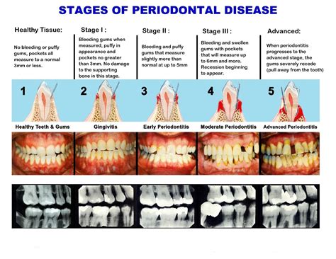 Walnut Creek Cosmetic Dentist Dr. Daniel R. Pestana DDS, APC: Stages of Periodontal Disease