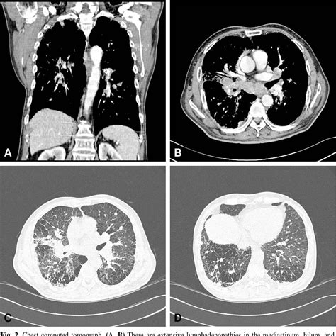 Figure 2 from A case of sarcoidosis in stonemason exposed to ...