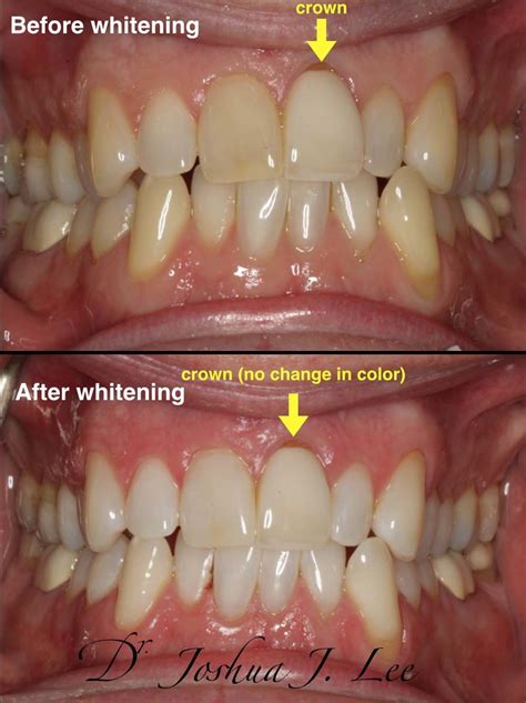 Zoom Whitening - Burlington Smiles Dental