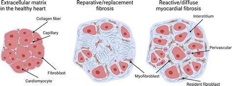 Frontiers | Cardiac Fibrosis in the Pressure Overloaded Left and Right Ventricle as a ...