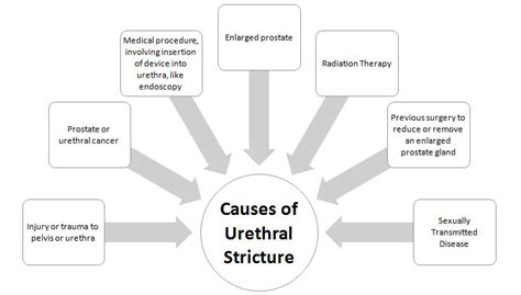 All About Urethral Stricture