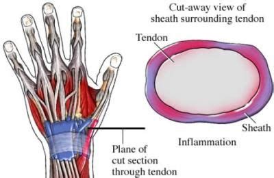 Pin on fibromyalgia (English)