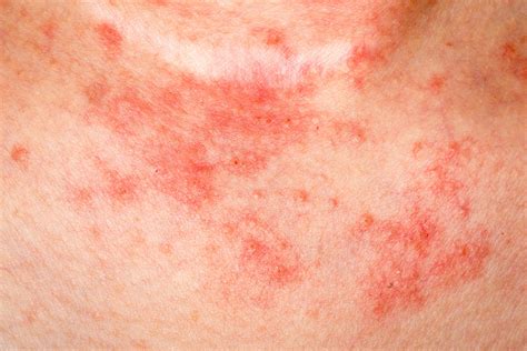 Eczema Causes, Symptoms, Diagnosis and Treatment - Natural Health News