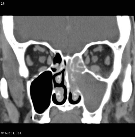 Acute sinusitis | Radiology Reference Article | Radiopaedia.org
