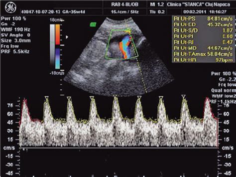 Internal Iliac And Uterine Arteries Doppler Ultrasound In, 43% OFF