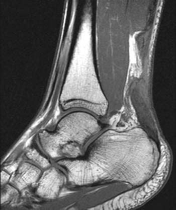 Achilles Tendon Tear Mri