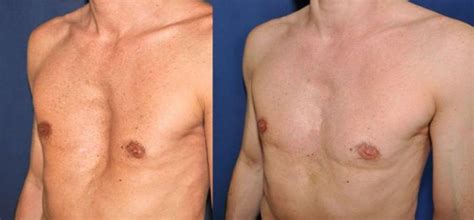 9 best All about pectus excavatum images on Pinterest | Chest exercises, Chest workouts and Surgery