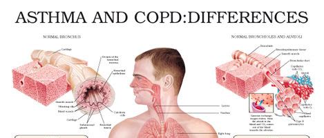 Asthma and COPD: differences – Anejo