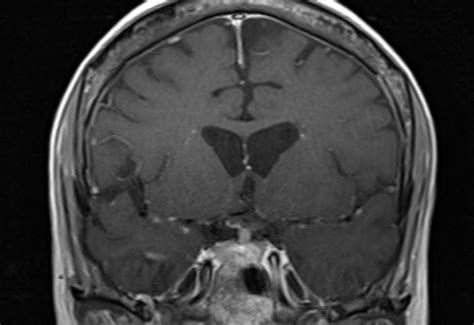 Pituitary Stalk Thickening - My Endo Consult