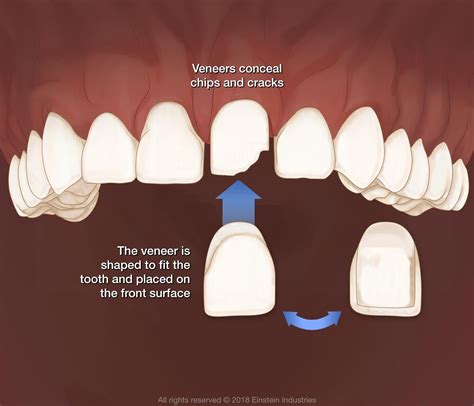 Porcelain Veneers - Albuquerque, NM - Parkway Dental