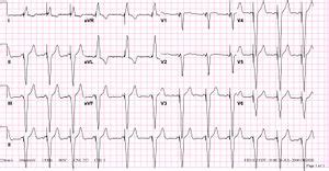 Pacemaker - ECGpedia