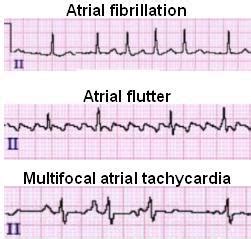 Atrial Flutter Vs Atrial Fibrillation Ecg