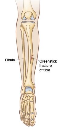 Greenstick Fracture - Types, Symptoms, Treatment