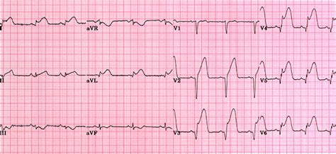 Acute anterolateral MI