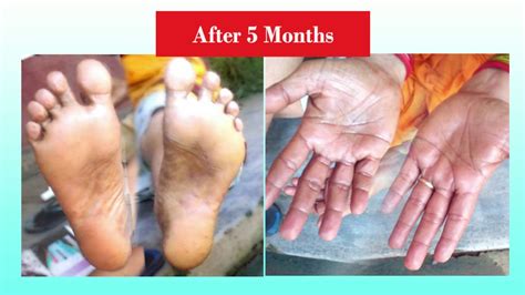 Psoriasis Success Story | Best Treatment of Plantar & Palmar Psoriasis - YouTube