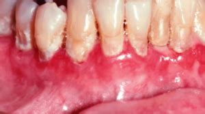 What is Mucous Membrane Pemphigoid?