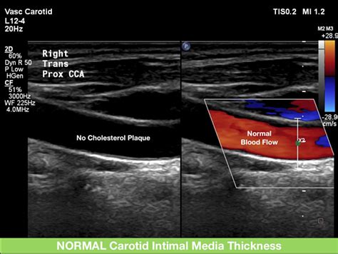 Carotid Ultrasound — SozoCardiology - Dr Ooi Yau Wei Interventional Cardiologist