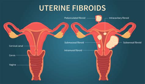 Fibroids Treatment in Mumbai Know Symptoms and Causes