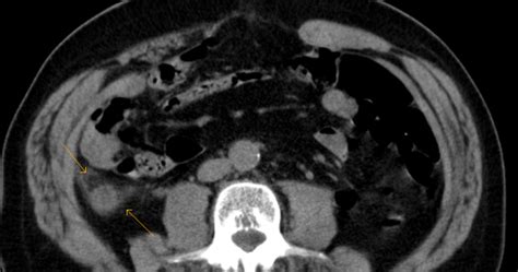 My Radiology Files: CT scan of a normal appendix vs Appendicitis