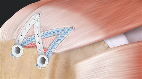 Arthrex - SpeedBridge™ Rotator Cuff Repair With Knotless SwiveLock® Anchors and AlloSync™ Buttons