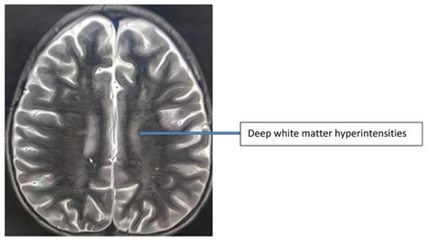 MRI of the brain: multiple enhancing confluent white matter lesions of... | Download Scientific ...