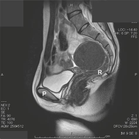 Pelvic MRI images are shown (sagittal view).Abbreviatio | Open-i