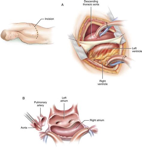 Special procedures in cardiac transplantation - Clinical Tree