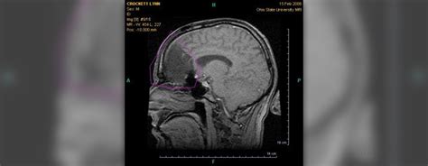 Side effects of mri scan | General center | SteadyHealth.com