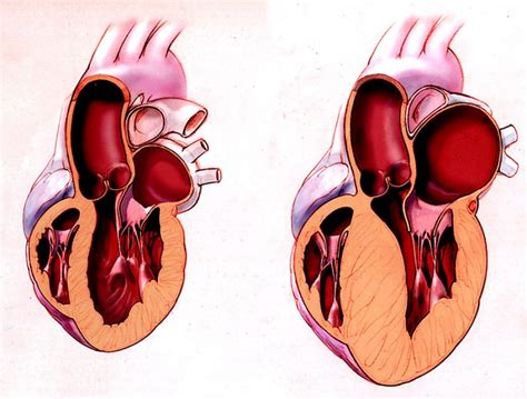 What is Hypertrophic Cardiomyopathy? - Cardiology Specialist Houston - Arsalan Shahzad, M.D. F.A ...