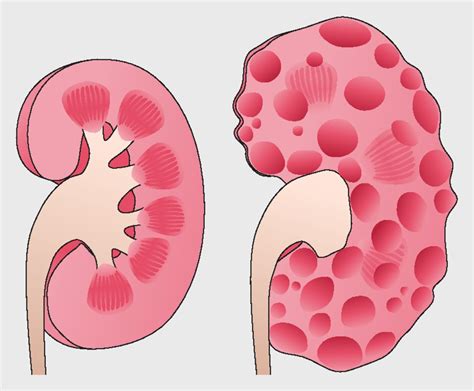 Polycystic Kidney Disease Ultrasound