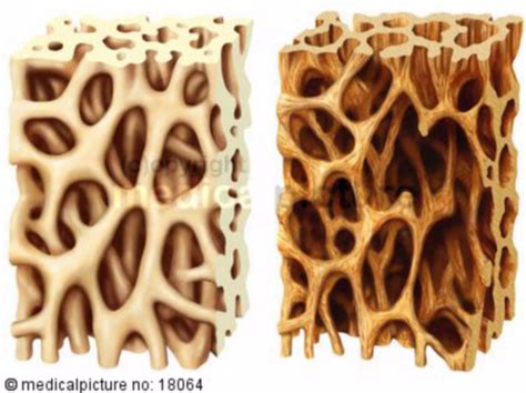 Healthy bone vs. osteoporosis - DocCheck