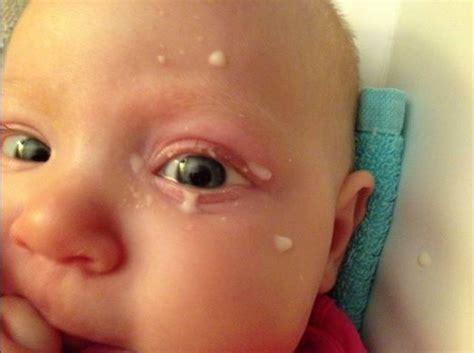 Home Remedies for Pink Eye in Toddlers, Babies (With images) | Pink eye ...