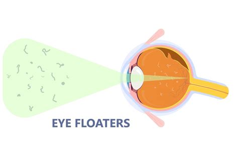 What Doctor Do I See for Eye Floaters? | Ottawa, ON